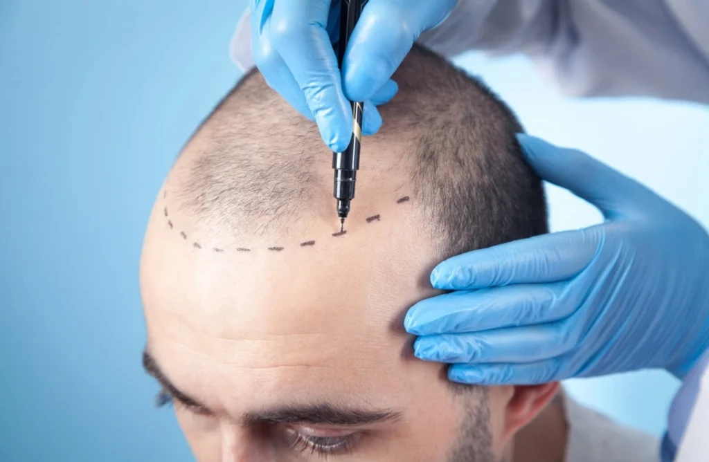 hair transplant medgeorgia